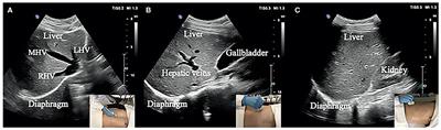 A Novel Normalized Cross-Correlation Speckle-Tracking Ultrasound Algorithm for the Evaluation of Diaphragm Deformation